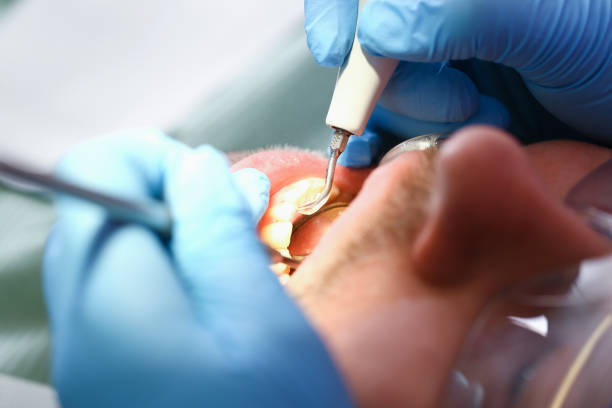 Best Emergency Wisdom Teeth Removal in San Bruno, CA