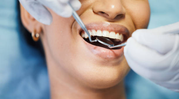 Best Emergency Tooth Extraction in San Bruno, CA